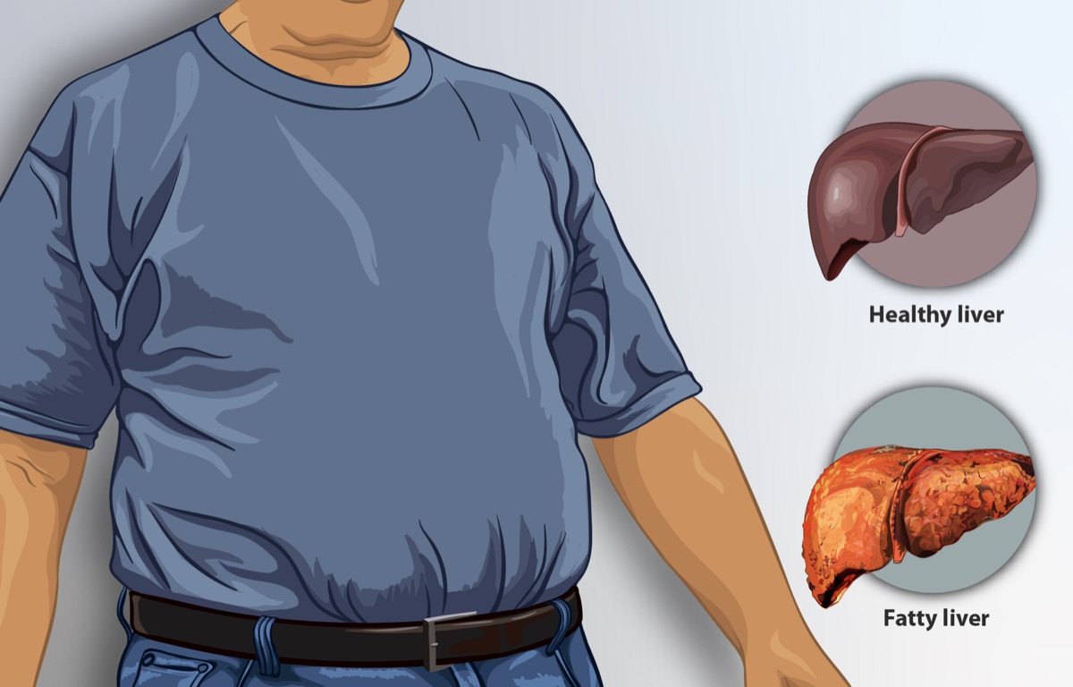 liver with fatty deposit