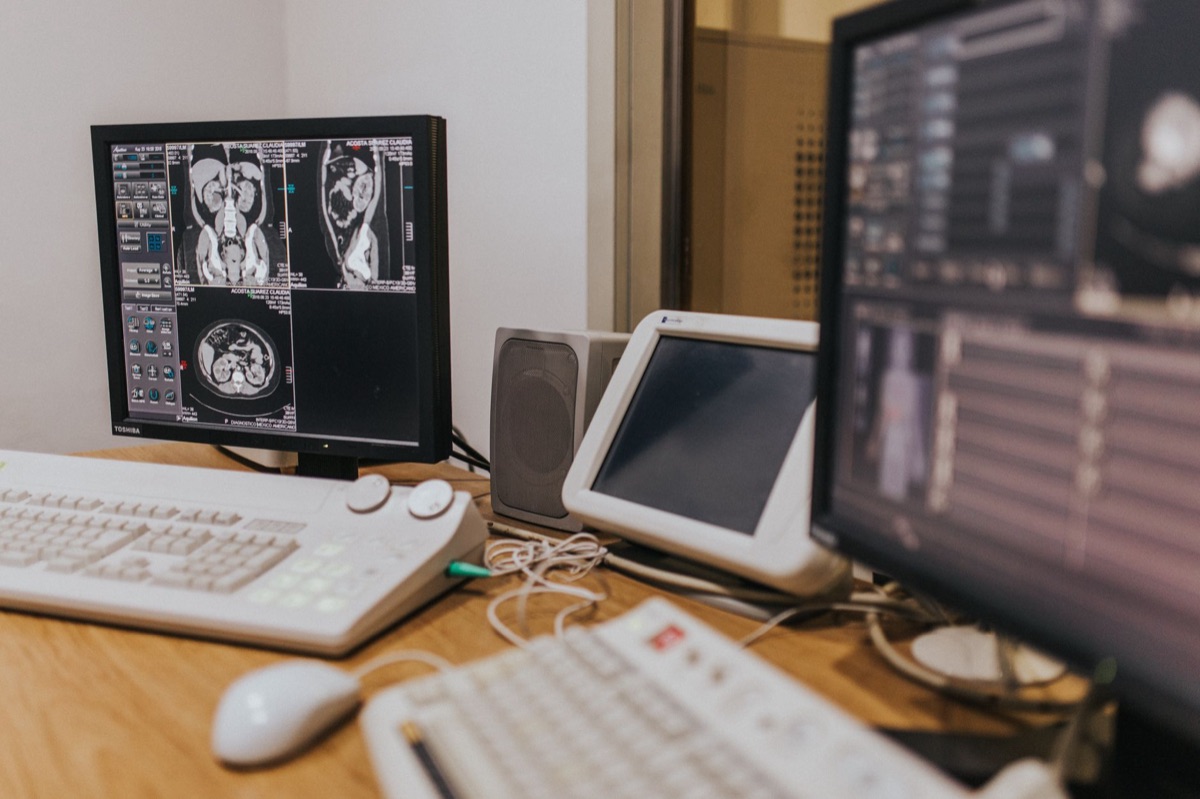 Medische scan van een lever met vetophoping.
