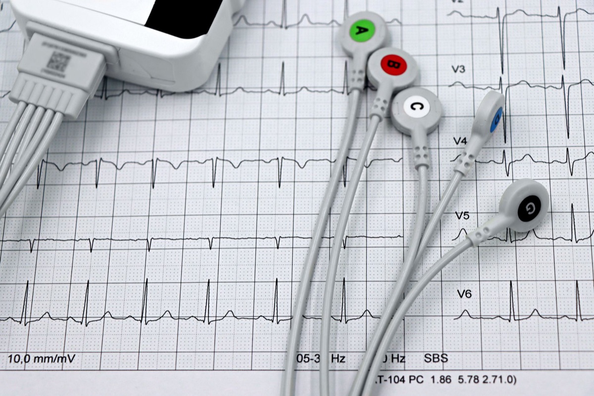 machine ecart electrocardiogramme