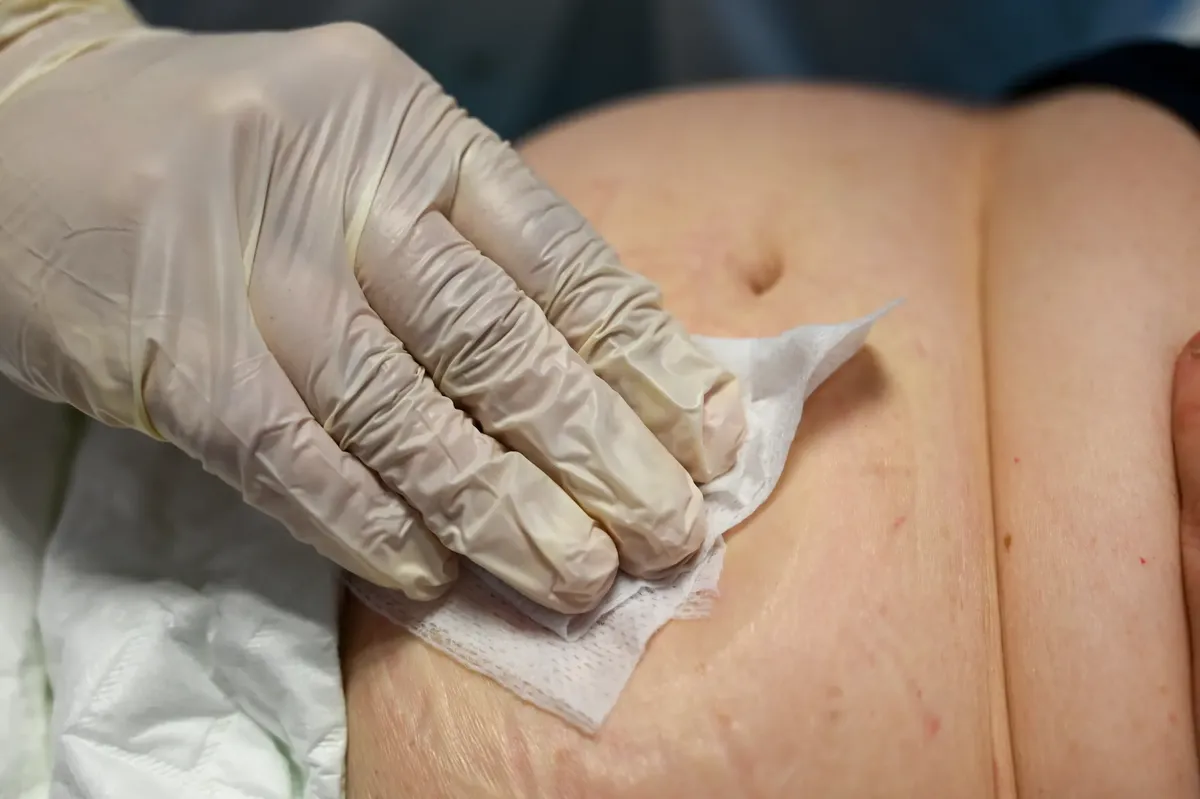 Close-up of a nurse cleaning a patient's ostomy area in a clinical setting.