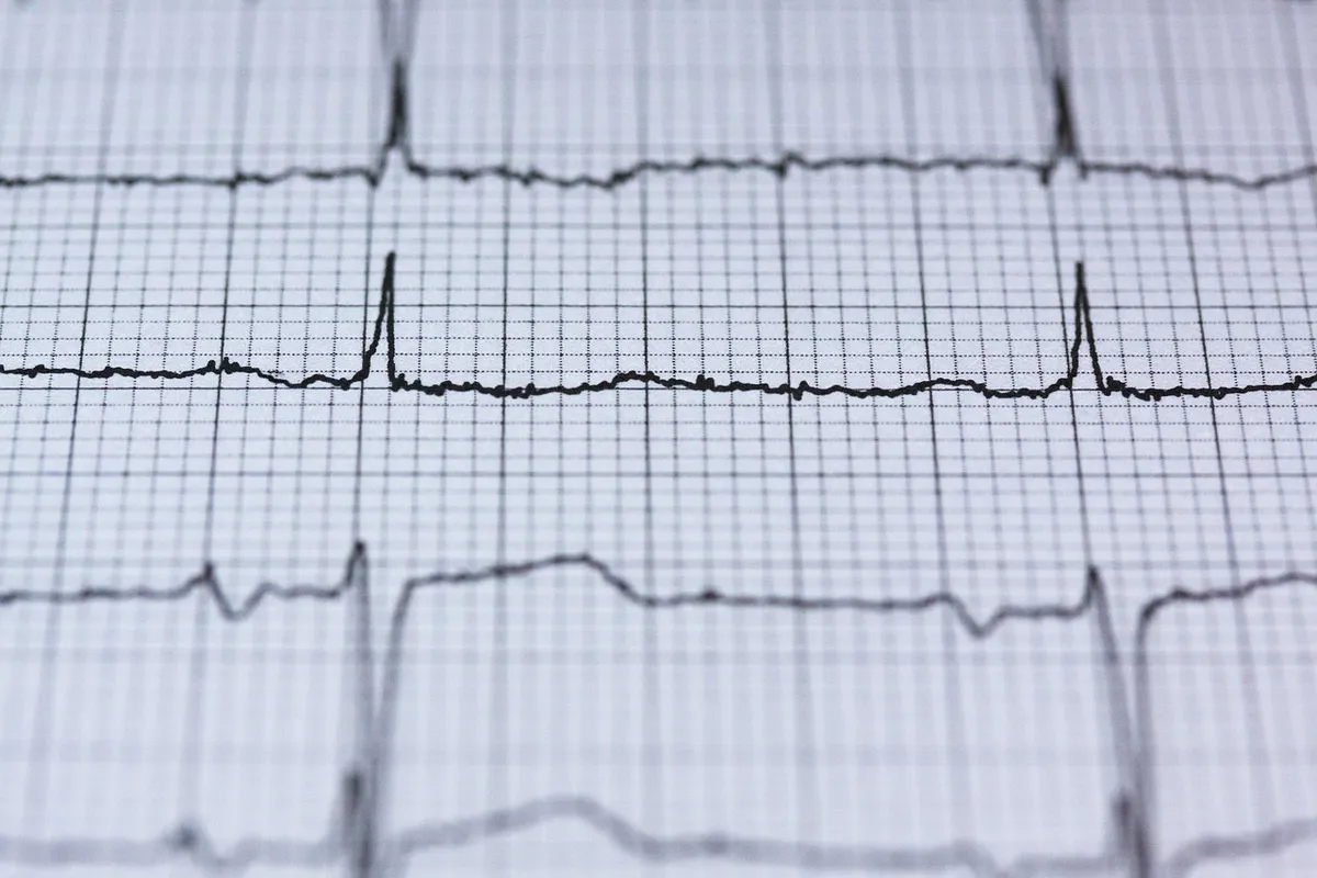 ecg, electrocardiogram, medicine, heartbeat, heart, frequency, curve, pulse, life, health, healthcare, circuit, examination, control examination, health check,
