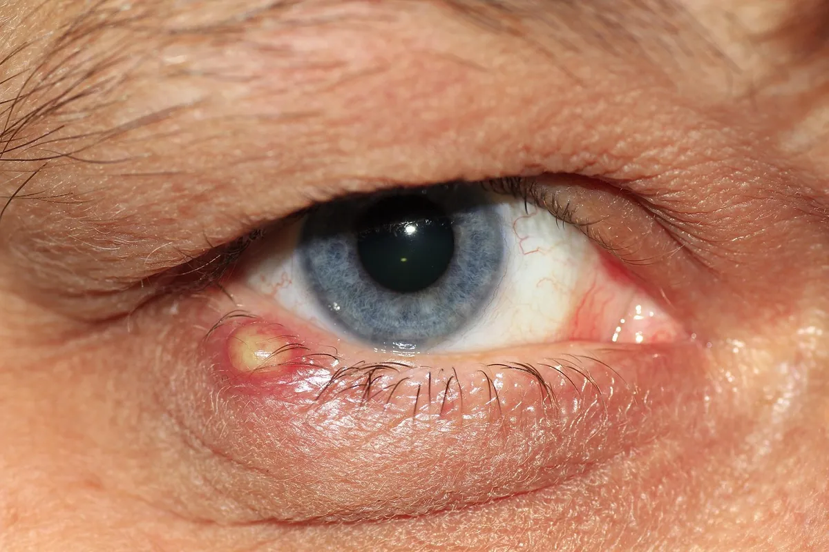 barley grain, eye, lid, pus, eyelashes, iris, blue, close up, bacterial inflammation, unpleasant, ill, illness, inflammation, pus, pus, pus, pus, inflammation,